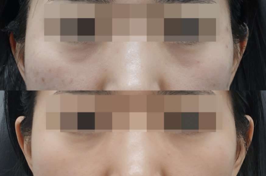 Undereye filler before and after