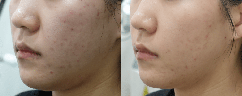 Under-Eye, Front Cheeks, Nasolabial Folds Before & After