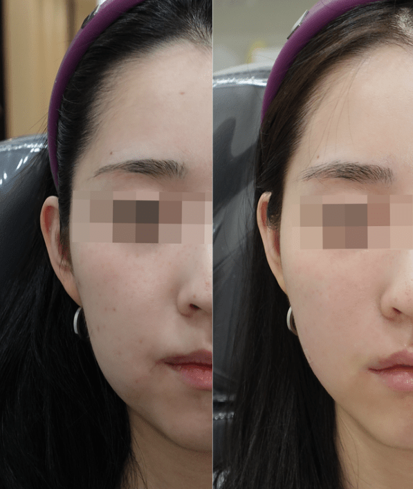 Best Areas for Ultherapy: Tips for Optimal&nbsp;Results